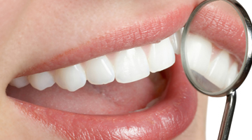 white composite fillings