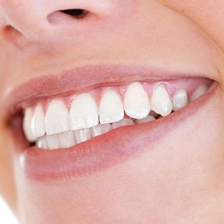 Teeth Whitening